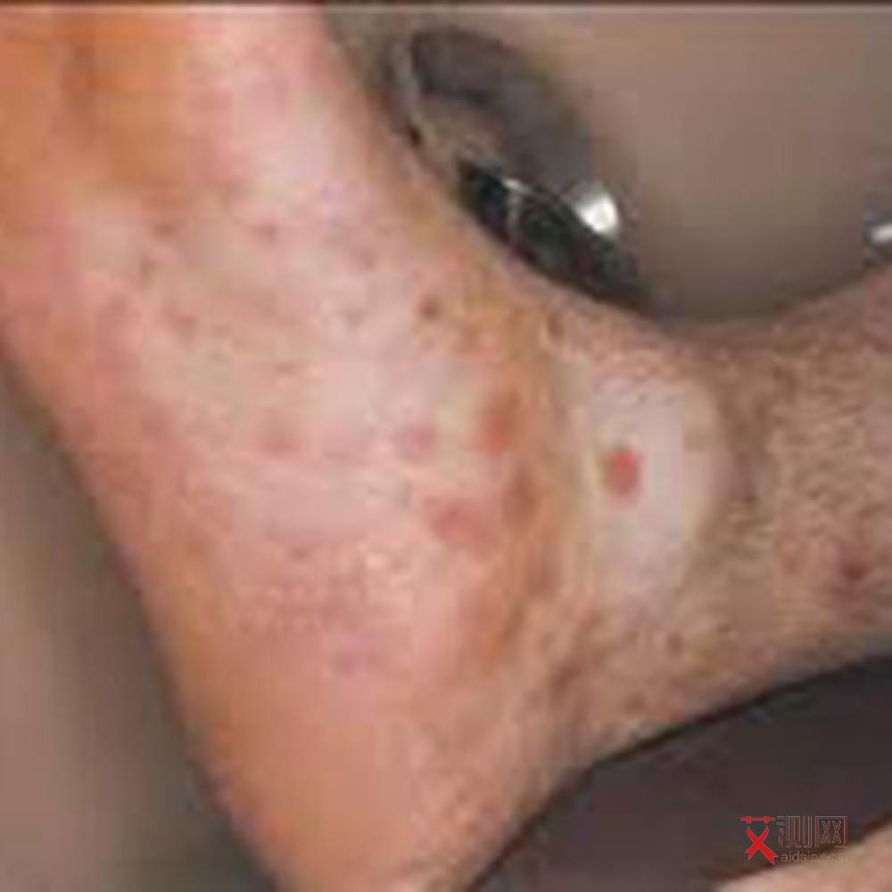 艾滋病早期典型症状是哪些症状