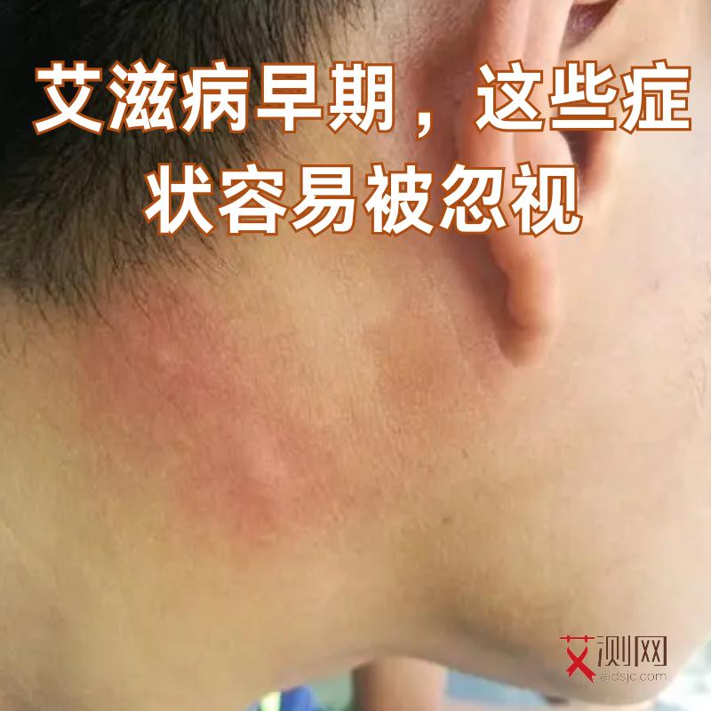 得上艾滋病多久会出现症状和症状呢