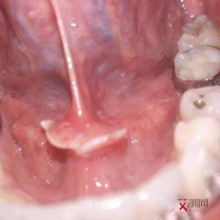 初次感染艾滋病的症状