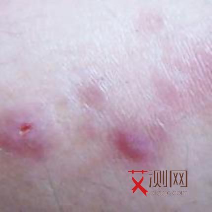 艾滋病有什么样的反应