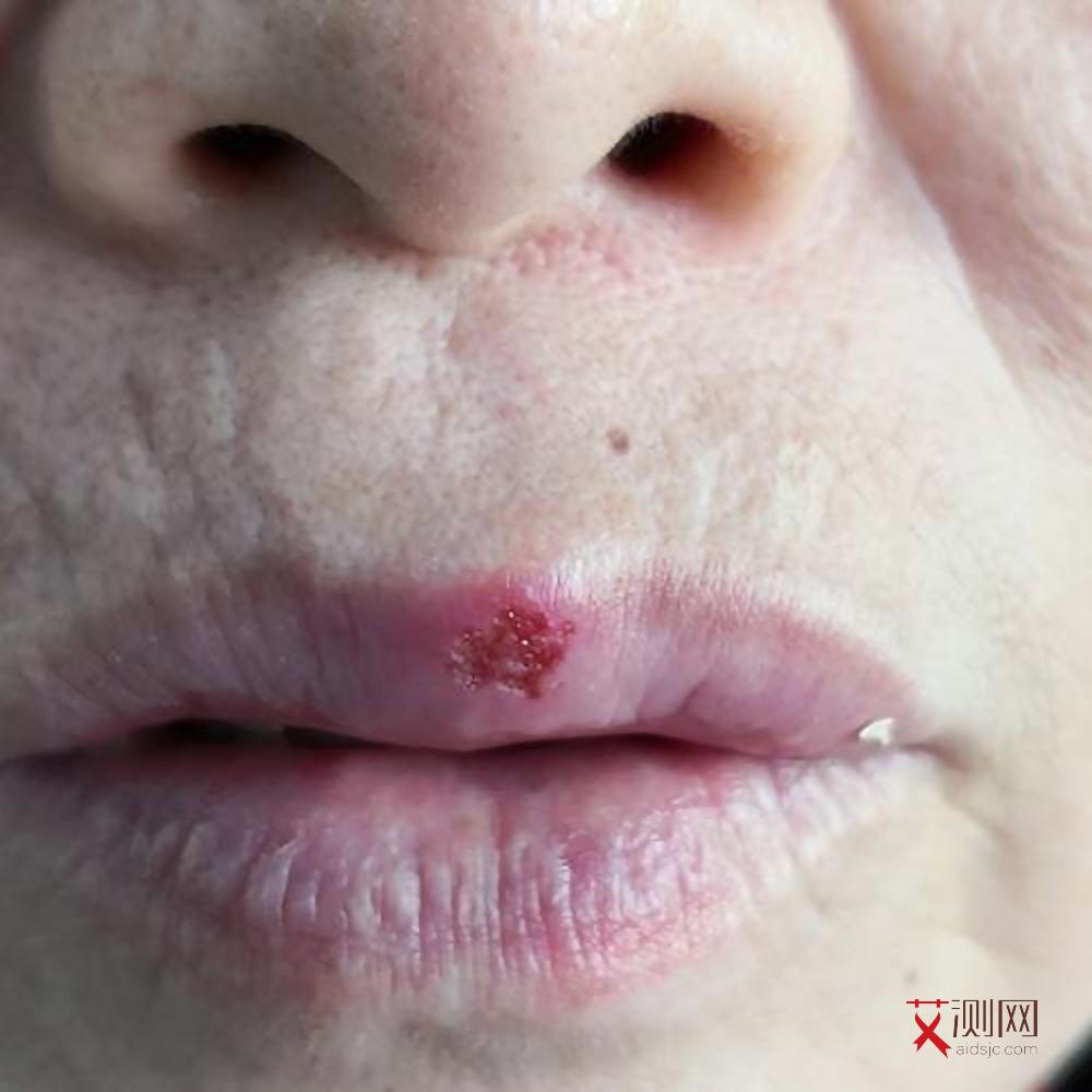 怎么检查自己有没有艾滋病和梅毒