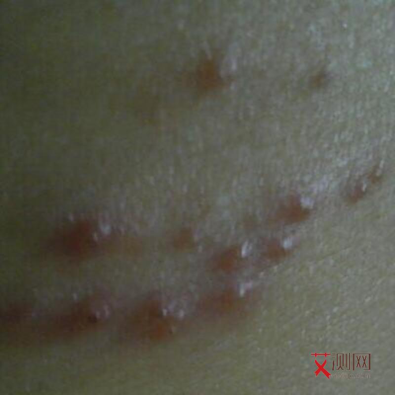 艾滋病人表现症状