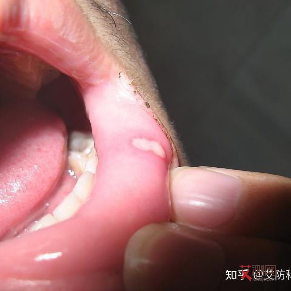 艾滋病多久算是早期症状表现