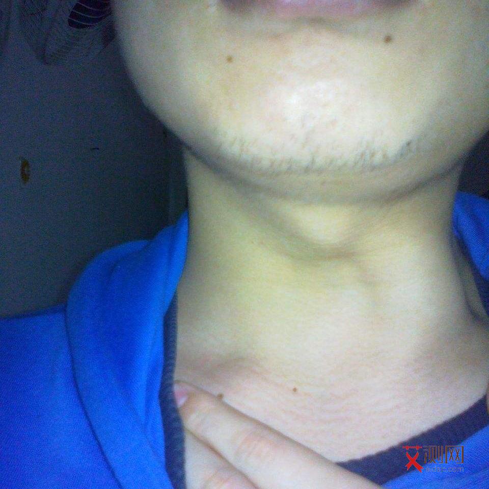 女人艾滋病皮疹一般在哪个部位出现