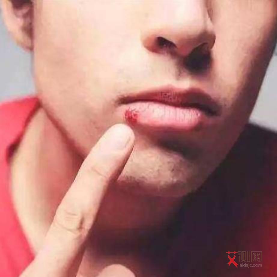 艾滋病毒嘴唇有什么症状图片大全