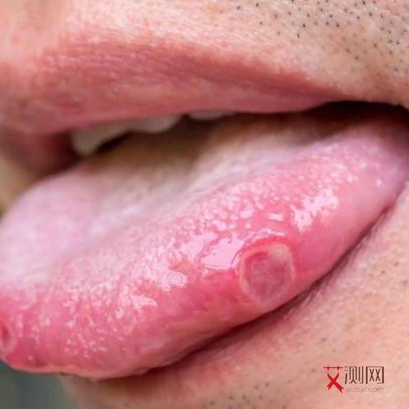 艾滋病的前兆人的皮肤会变黑吗会传染吗