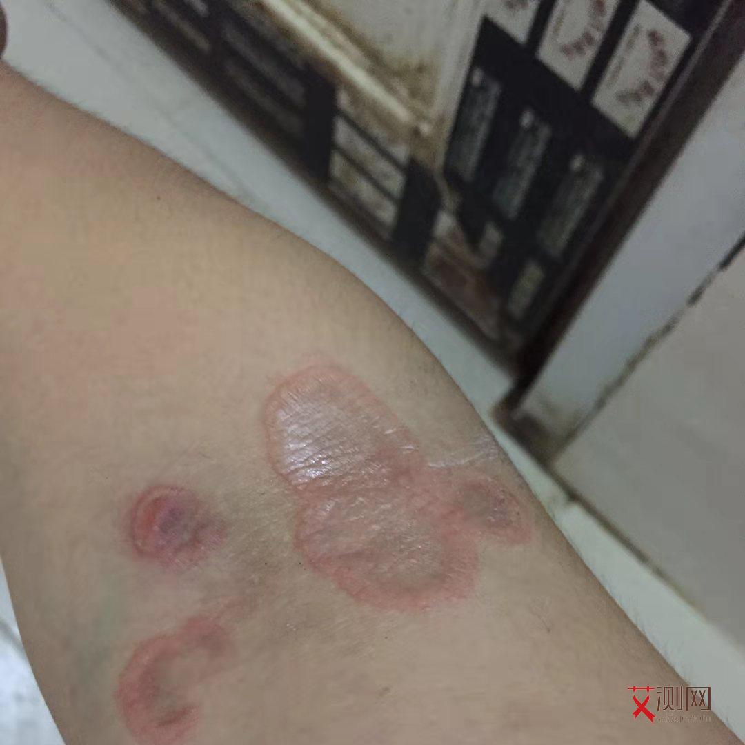 艾滋病的初期症状图片大全女性