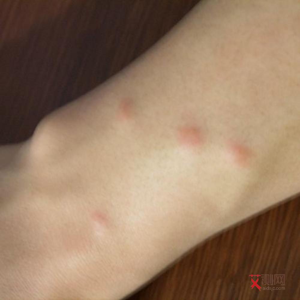 艾滋病征兆是什么表现呢