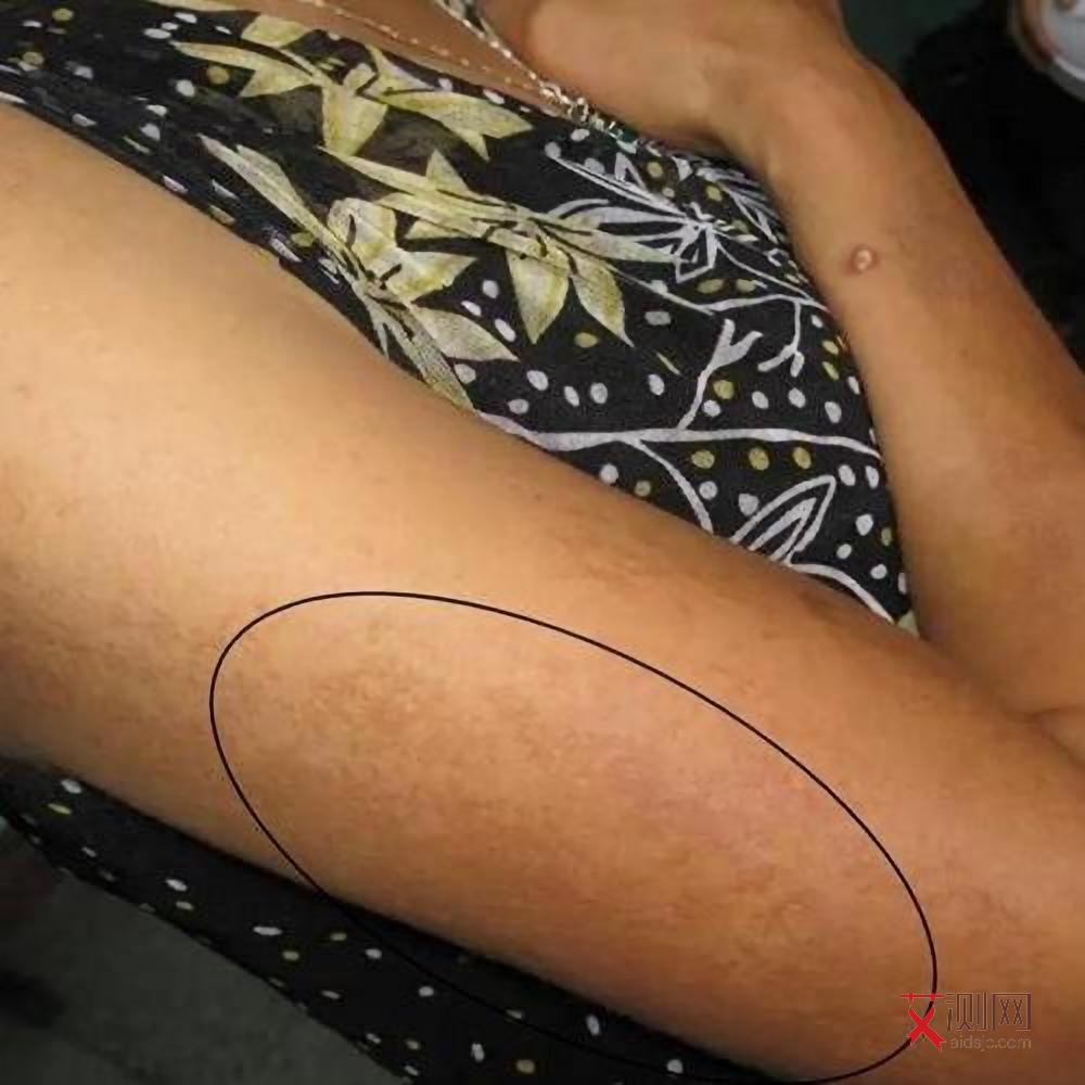 艾滋病的初期症状图片大全女性