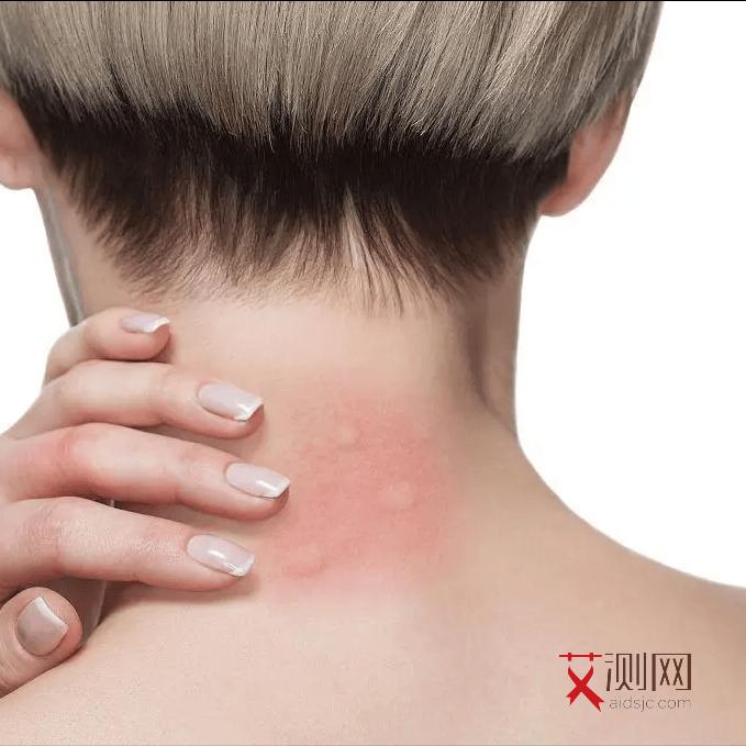 艾滋病感染后最快几天可产生症状出现