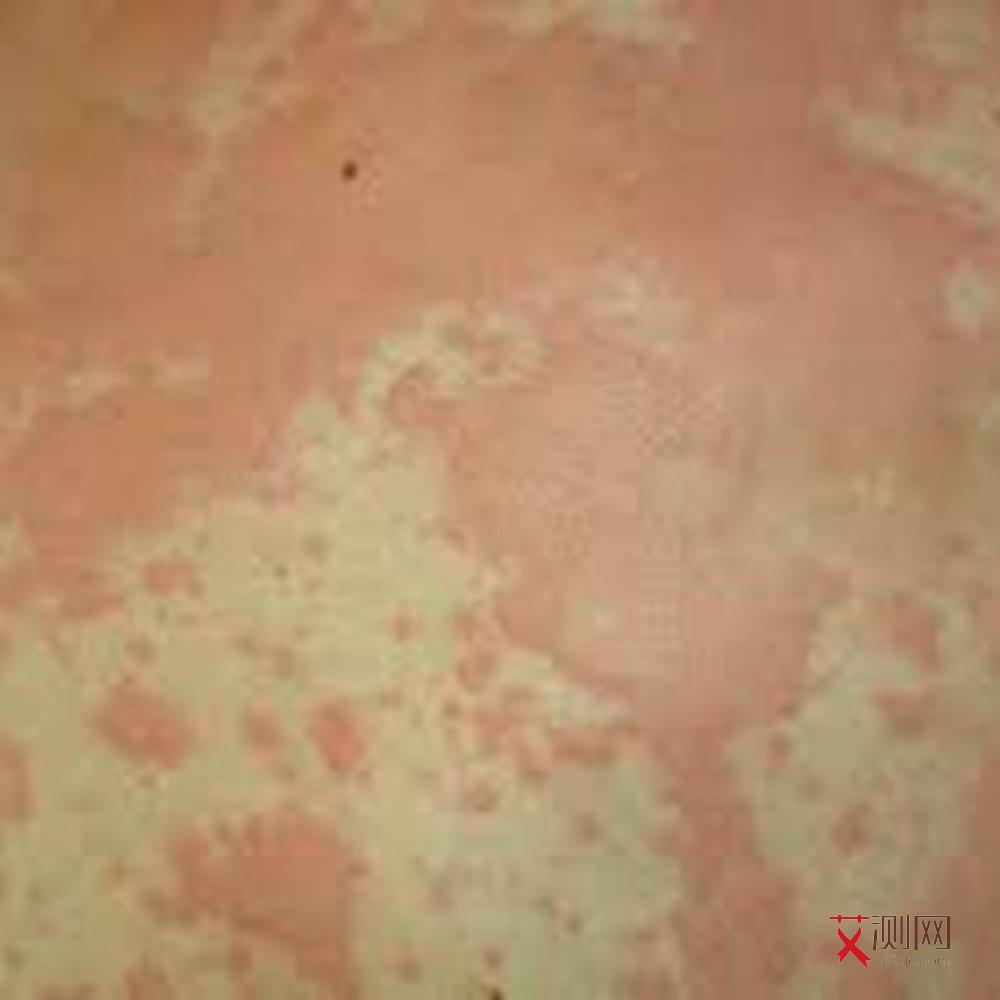 艾滋病症状及治疗原则是什么