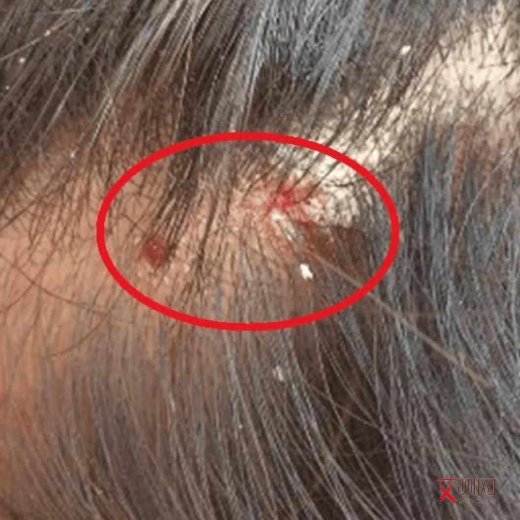 艾滋病的皮疹一般是多久可以消下去