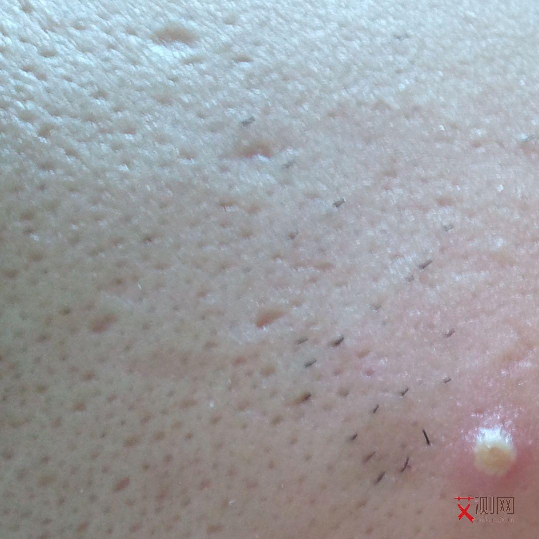 艾滋病皮疹形状图片