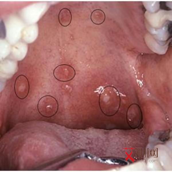 艾滋病发烧淋巴结一定肿大吗会传染吗女性