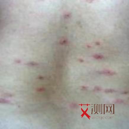 艾滋病嘴唇有什么症状图片女性