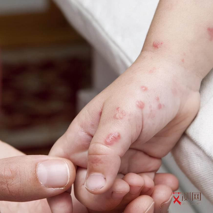 得艾滋病会有口腔溃疡吗会传染吗图片