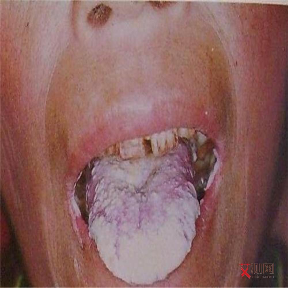 艾滋病的早期口腔表现照片