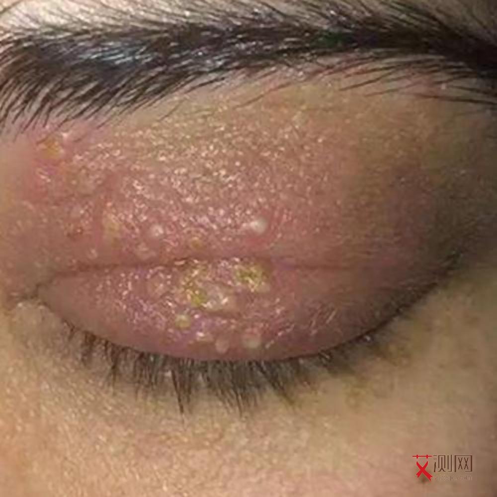 怎么查自己是否得艾滋病毒