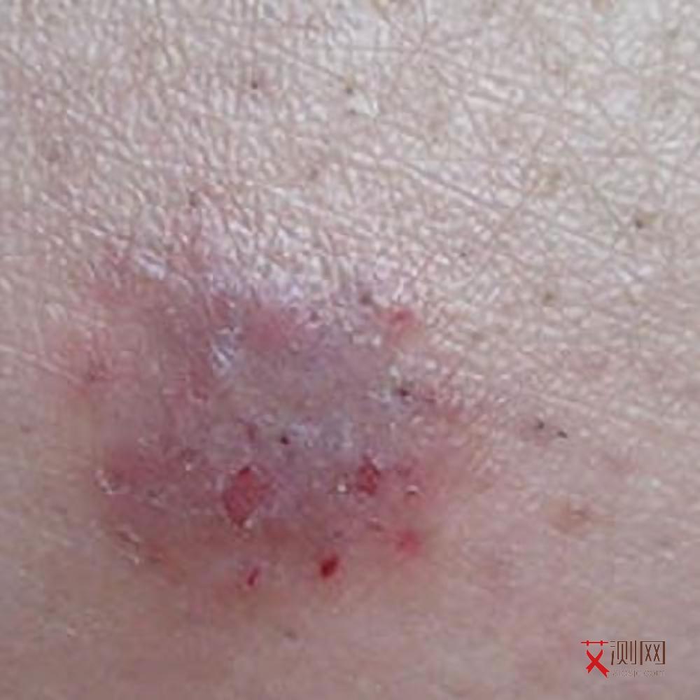 艾滋病患者唾液能传染吗