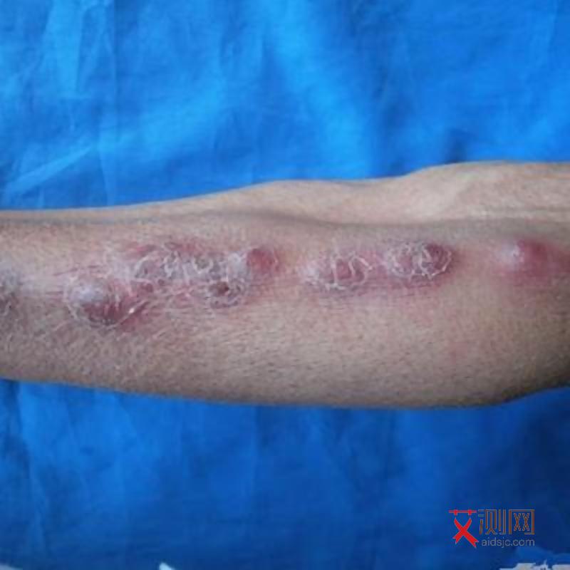 害怕艾滋病吓出病了