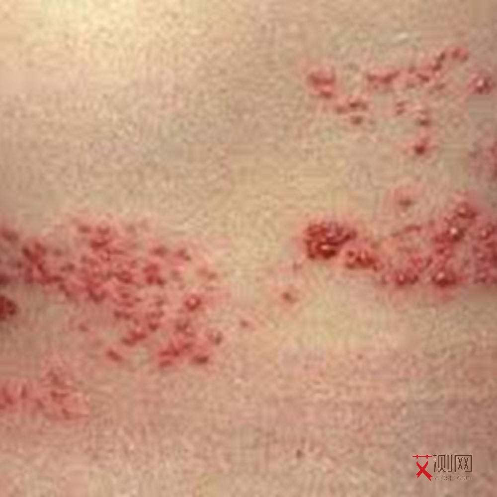 艾滋病人有哪些症状图片大全图解