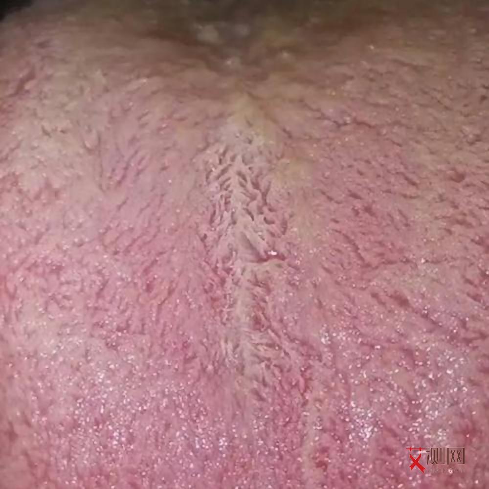 艾滋病淋巴结肿大多久才能消