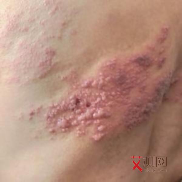 女艾滋病症状有哪些表现