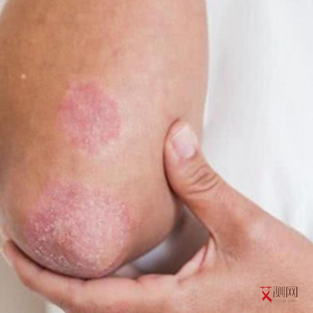 艾滋病女性症状初期征兆表现是什么