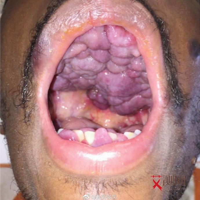 疾控发现艾滋病的处置方法是