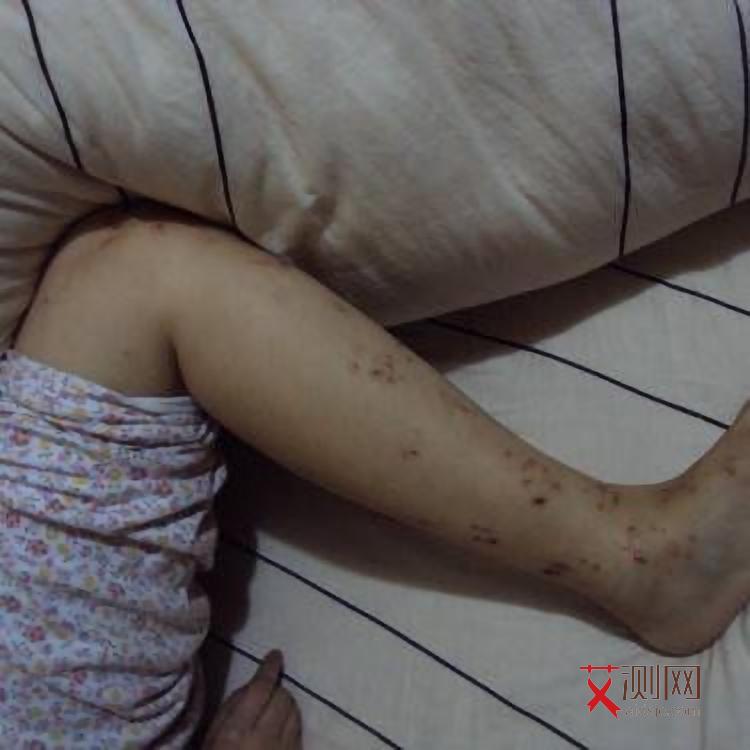 牙龈出血碰到艾滋病血会传染吗图片