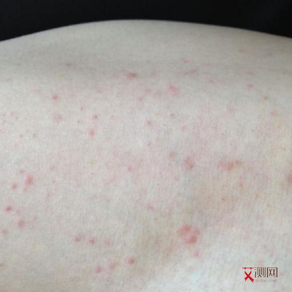 艾滋病的初期症状是什么样的图片和症状