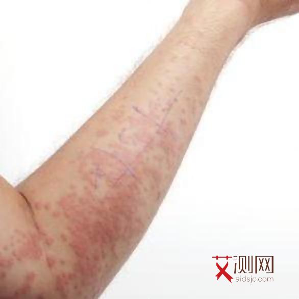 艾滋病初期红点会痒吗图片女性