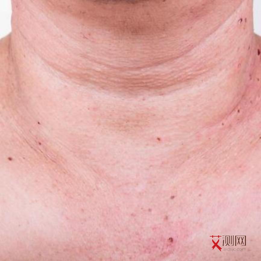 艾滋病症状身上起红点痒吗怎么治疗好
