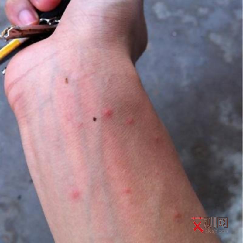 艾滋病多久能发现症状呢