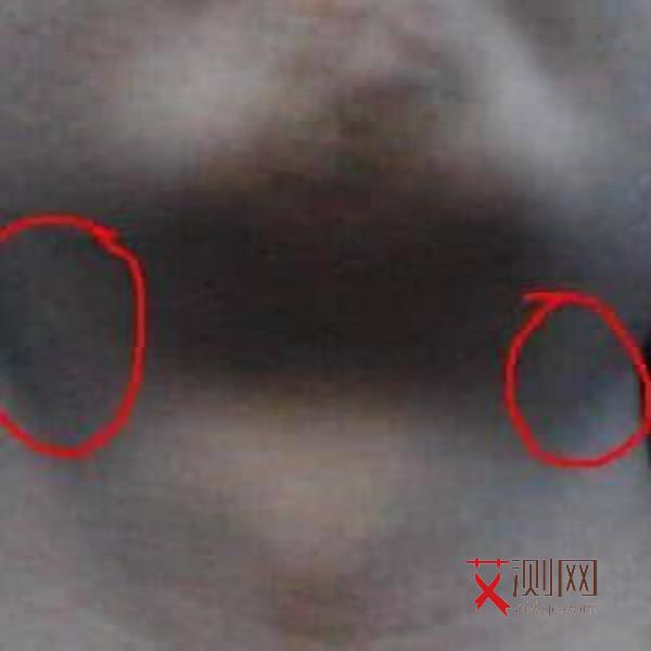 艾滋病初期小红点特征有哪些症状