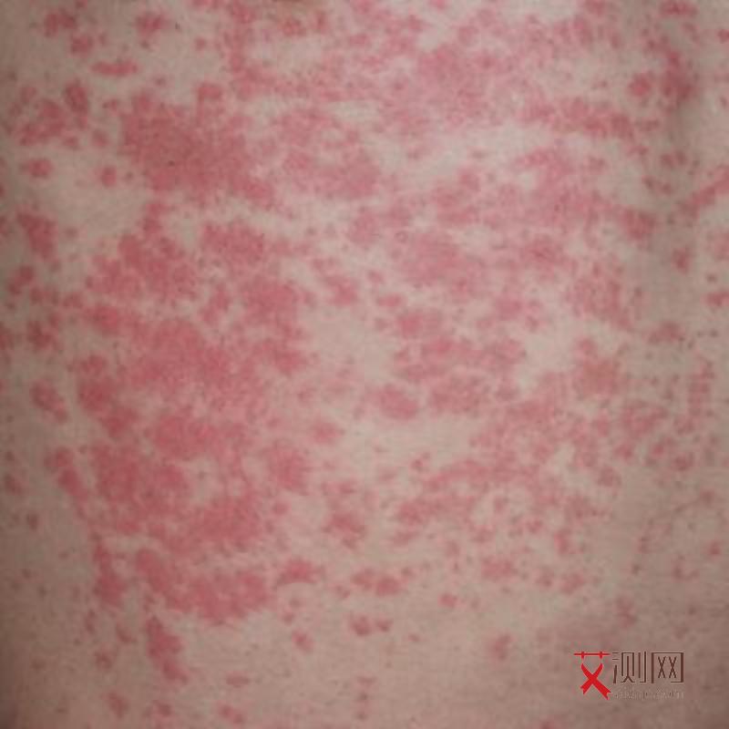 艾滋病感染口腔表征的诊断标准为