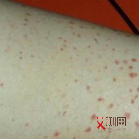 艾滋病的初期症状皮疹会痒吗会传染吗图片