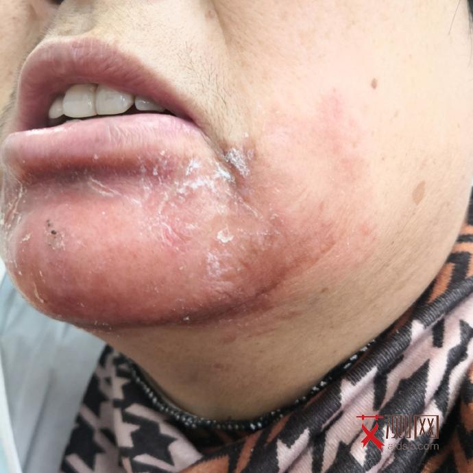 艾滋病人屁股有什么症状图片