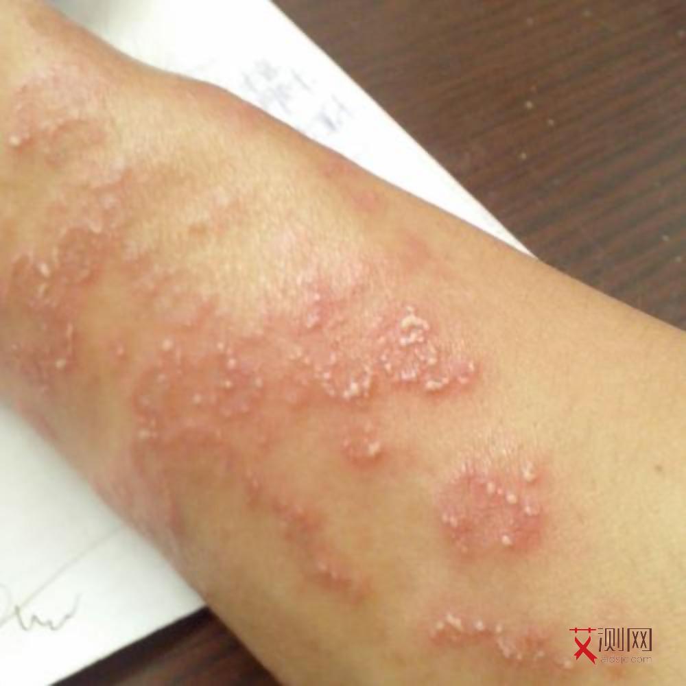 艾滋病下体有什么异常吗会传染吗图片女性