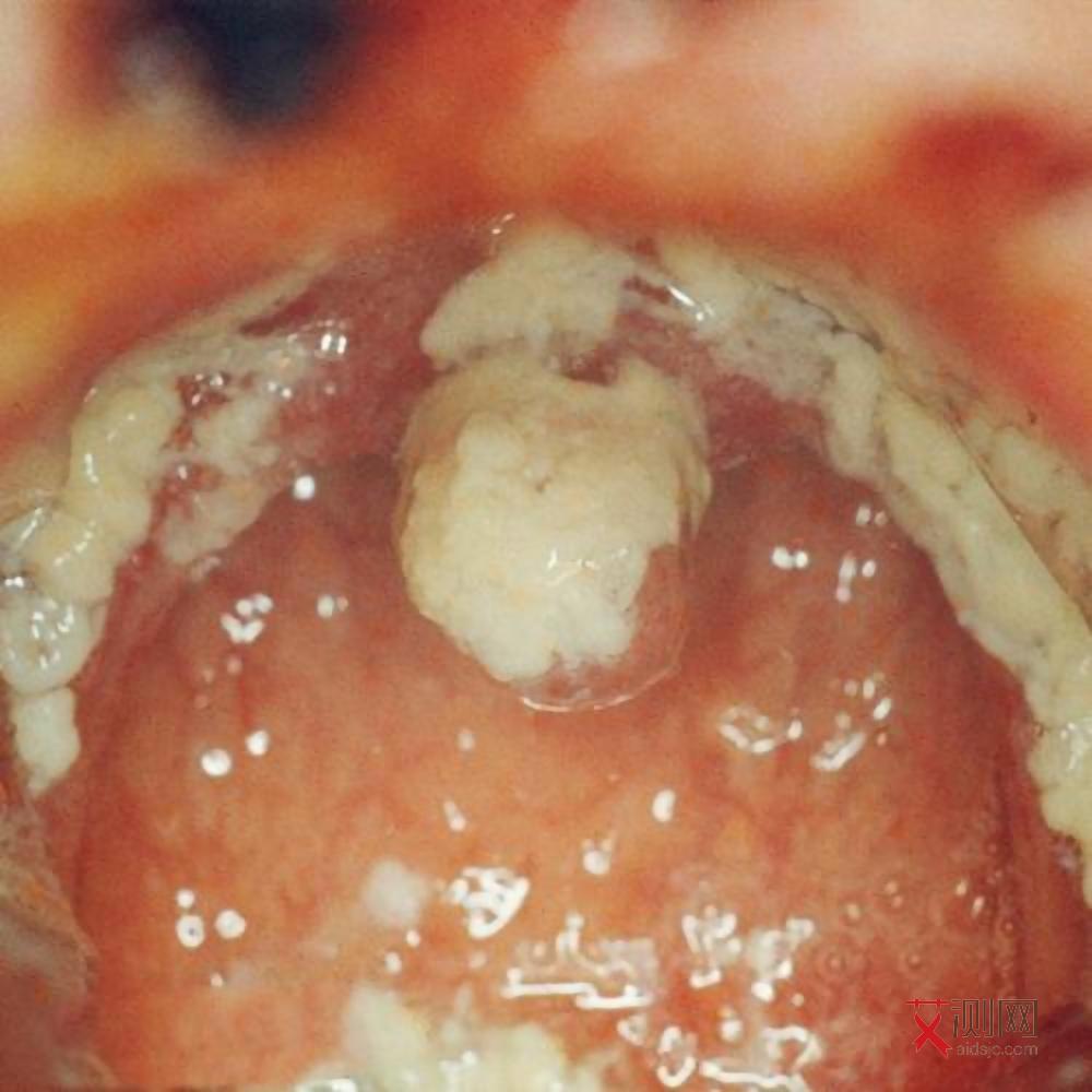 艾滋病小红点会不会流血呢图片