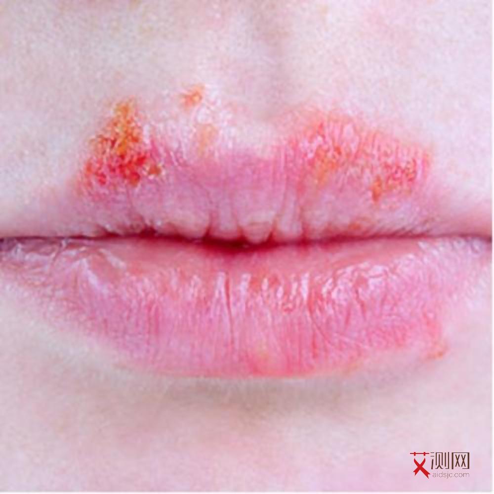 艾滋病人胸闷怎么治疗效果好