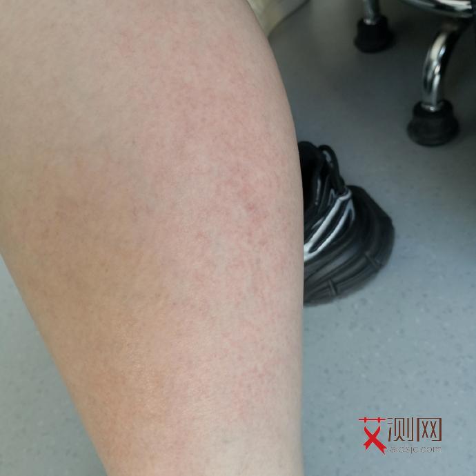 艾滋病外在症状图片