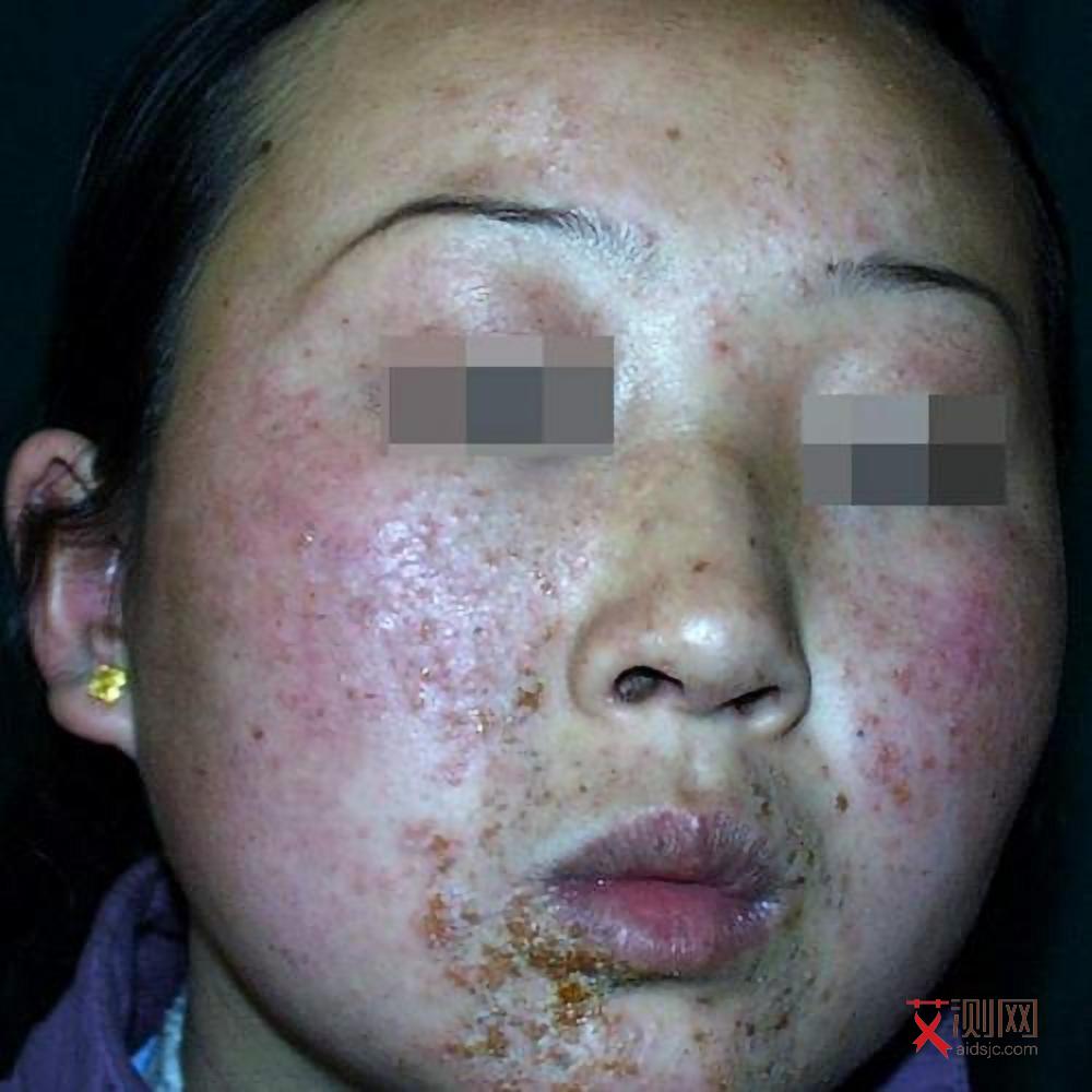 女生得艾滋的几率是多少