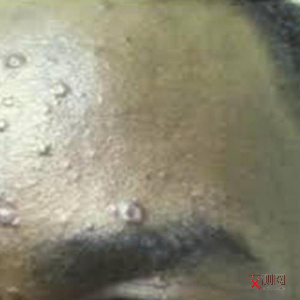 艾滋病的最常见症状是什么样的男性