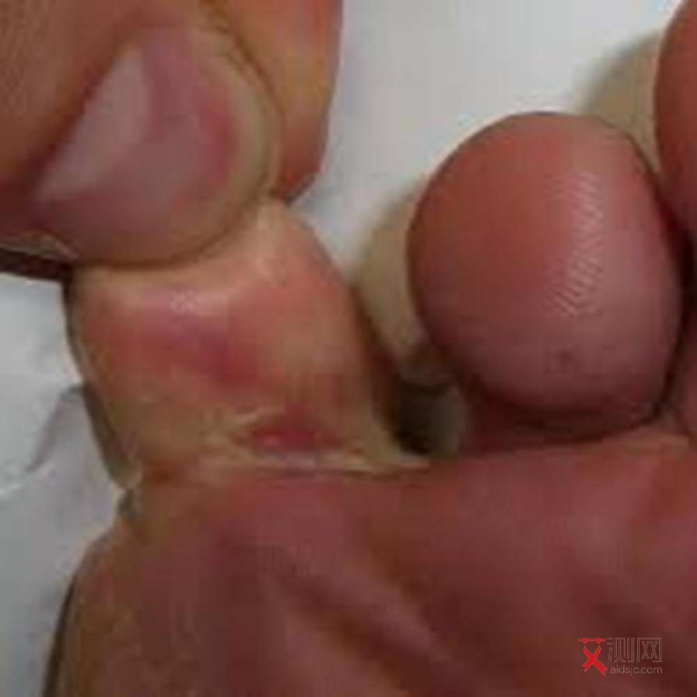 艾滋病全身红疹多久会消退完