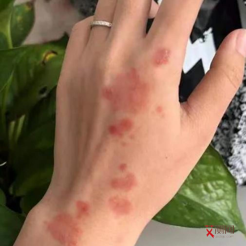 艾滋病女初期症状及表现图片大全图解