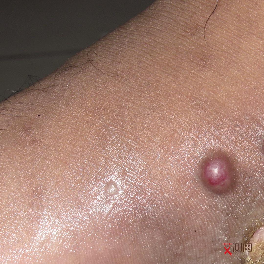 艾滋病多久起红疹图片和症状大全