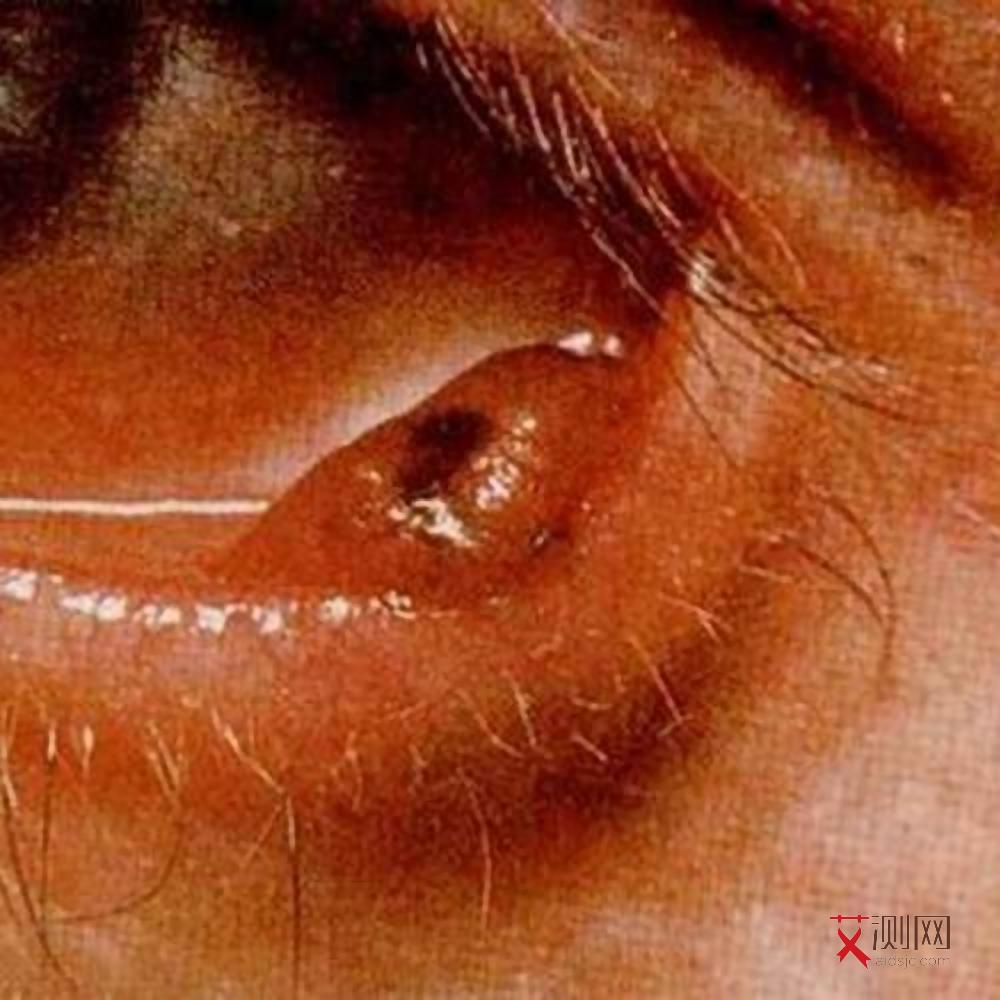 艾滋病人身上出现红点图片和症状大全图解