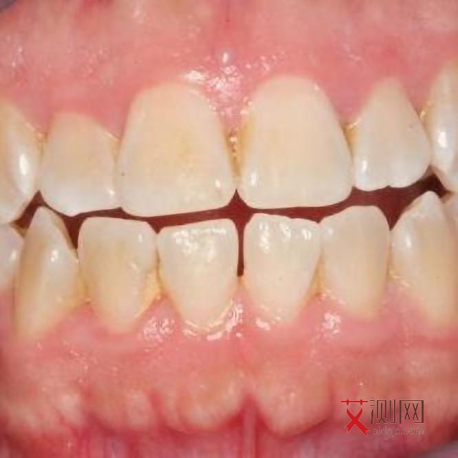 艾滋病感染后多久出现淋巴结肿大症状呢