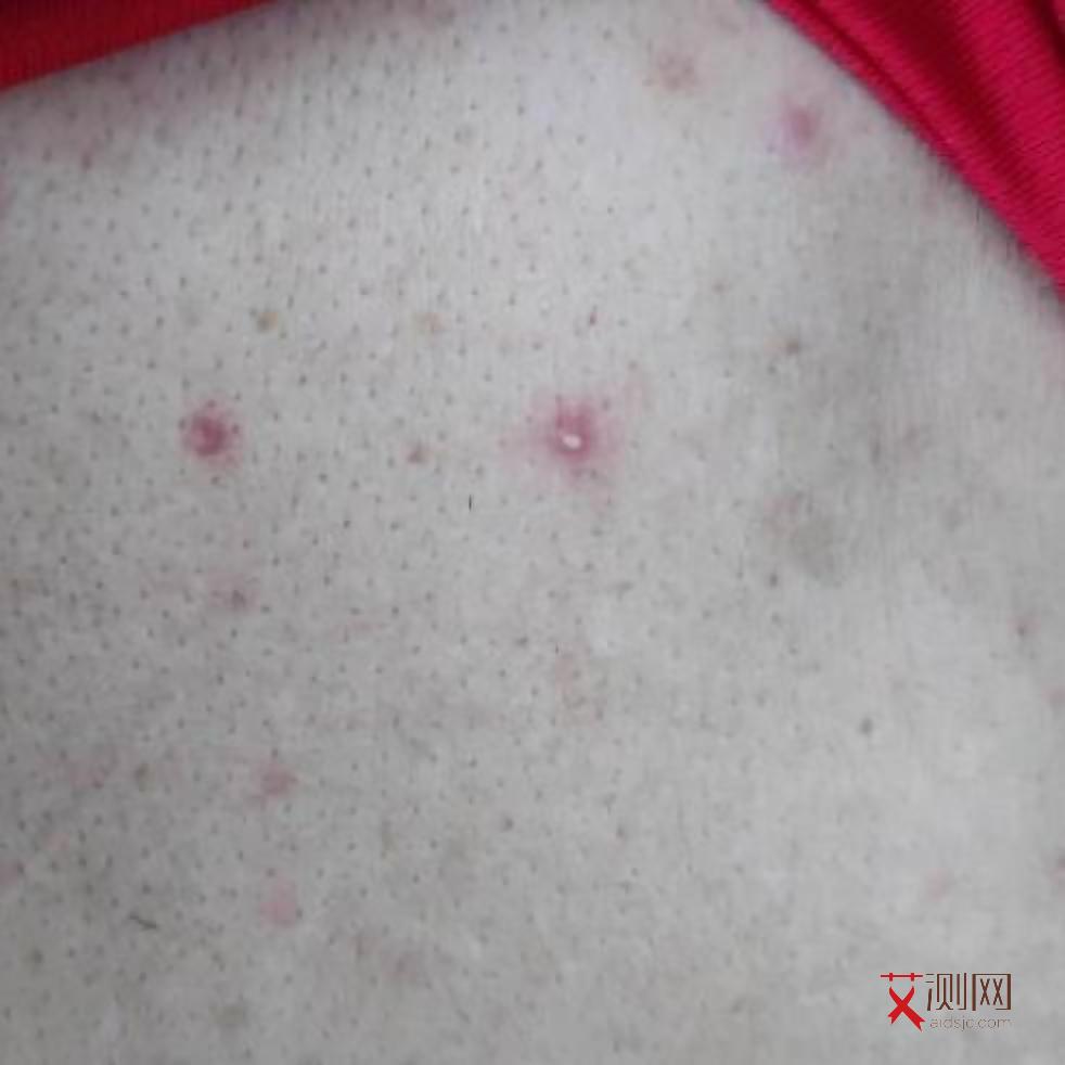 江苏省疾控中心艾滋病咨询电话号码是多少